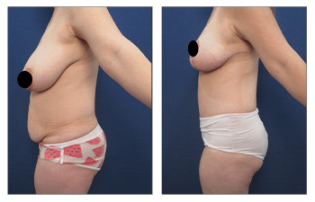 Creating The Best Belly Button For A Tummy Tuck