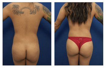 best brazilian butt lift surgeon