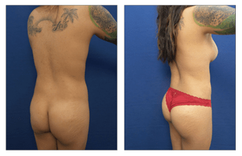 Brazilian Butt Lift Newport Beach, BBL Orange County