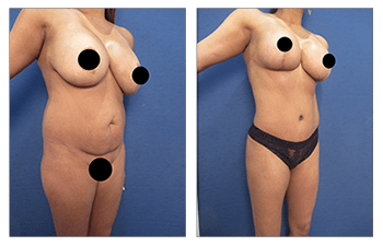 Best Liposuction, Tummy Tuck