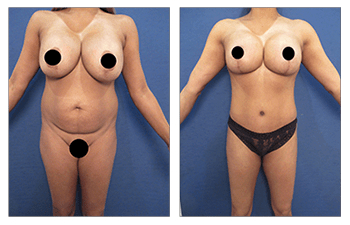 Best Breast Reduction Denver, CO  Denver Liposuction Speciality