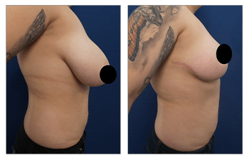 How to Fix Uneven Breasts?  Dr. Mazaheri - Plastic Surgery