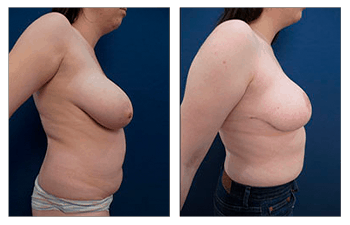 Breast Lift with Implant Exchange