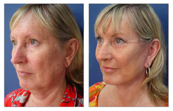 Face and neck lift San Diego - Ideal Earlobe Shape with Every Facelift