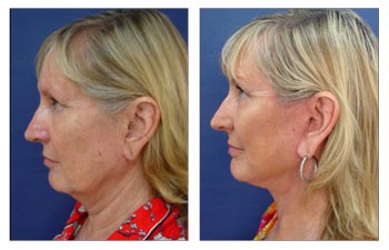 Ideal Earlobe Shape with Every Facelift