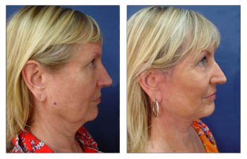 Earlobe procedures Los Angeles - Ideal Earlobe Shape with Every Facelift