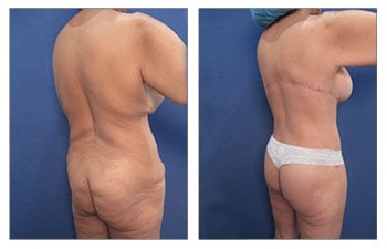 Taking Control of Your Body Contours With Liposuction High Point, NC