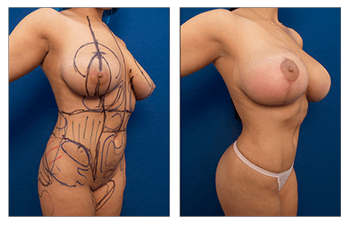 VASER liposuction for abdominal etching