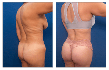 Liposuction vs Laser Lipo, What Makes Laser Liposuction Different?