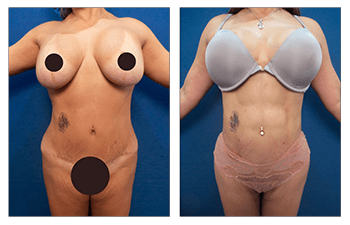 Smart Liposuction Photo Gallery - Belred Cosmetic Surgery