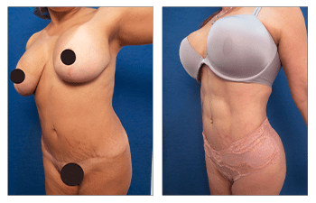 Laser Lipo vs VASER Lipo  Cosmetic Plastic Surgery Institute