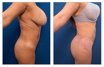 Laser Liposuction vs Traditional Liposuction - AllWhite Laser