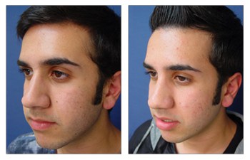 Closed Rhinoplasty Cost | Get you deformities corrected at....