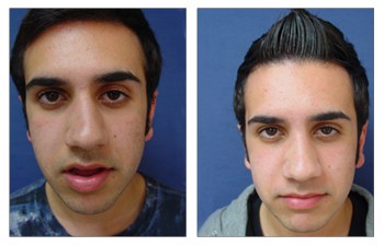 Closed Rhinoplasty Cost Get you deformities corrected at