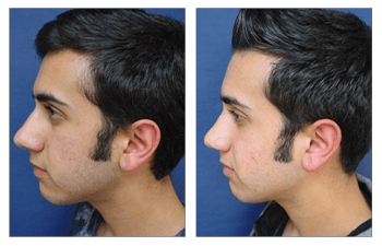 Closed Rhinoplasty Cost Get you deformities corrected at