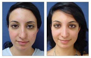 Closed Rhinoplasty Before and After Cosmetic Plastic Surgery