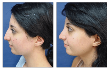 Closed Rhinoplasty Before and After