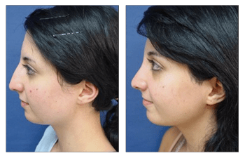 Closed Rhinoplasty Before and After Cosmetic Plastic Surgery