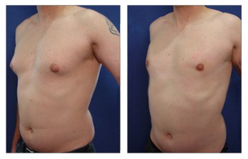 Gynecomastia Healing Side Effects