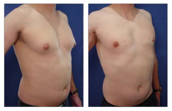 What To Expect After Gynecomastia Surgery Dr Mowlavi