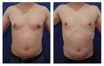 Male Breast Surgery Recovery