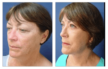 Face Lift and Neck