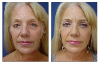 Neck Lift Recovery, Cosmetics Surgery