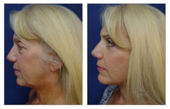 The Natural Lift - Bay Dermatology and Cosmetic Surgery