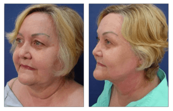 Face Lift and Neck