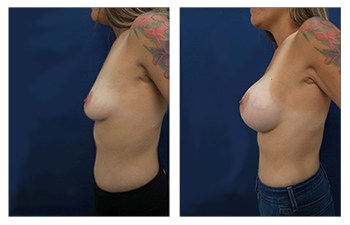 Breast Implants Los Angeles