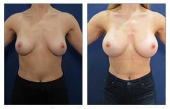 Breast Augmentation Silicone vs Saline