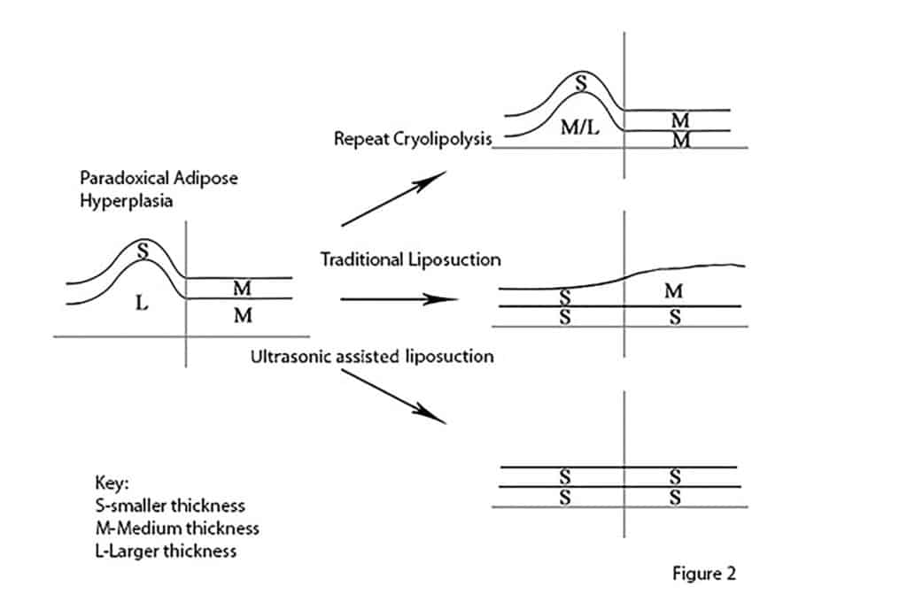 Definitive Treatment of PAH (Paradoxical Adipose Hyperplasia)