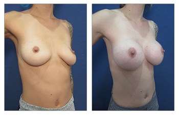 Breast augmentation Dana Point