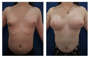 Breast Surgery Newport Beach