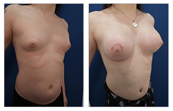 Breast augmentation transgender MTF Transgender