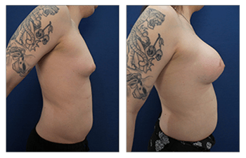 Transgender Breast Surgery