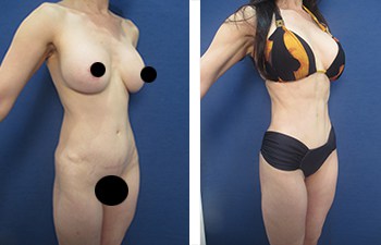 Lipo 360 Austin, TX - Aspira Plastic Surgery