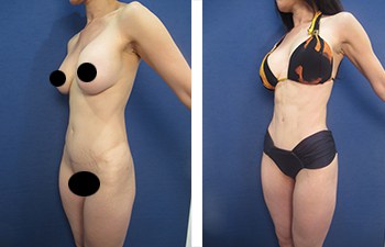 Patient C - Post-Operative Back & Bra line and Hips Liposuction — Dr  Giuffre Plastic Surgeon Edmonton