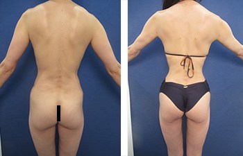 Mini Tummy Tuck Los Angeles