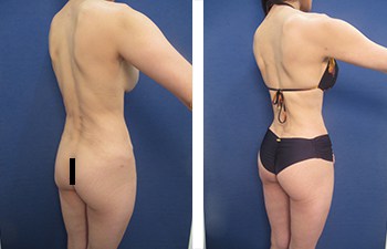 Slim Every Side of Your Body With Liposuction 360, Plastic Surgery for  Tracy, CA