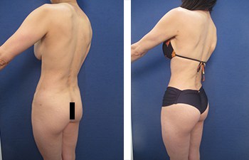 Sculpt with Liposuction  San Diego Body Contouring