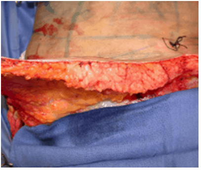 What Is Paradoxical Adipose Hyperplasia (PAH?) - AI Plastic Surgery