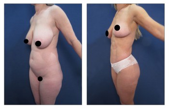 High Definition Liposuction Results, CPSI