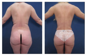 Waistline Narrowing  With HD Lipo - High Definition Liposuction