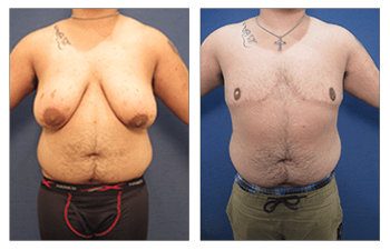 Transgender Female to Male Breast Surgery Our Surgical Team