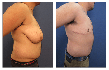 Transgender Female to Male Breast Surgery Our Surgical Team