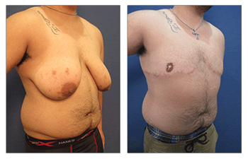 Transgender Female to Male Breast Surgery Our Surgical Team