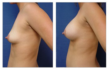 Breast Implant Augmentation - Newport Beach plastic surgery