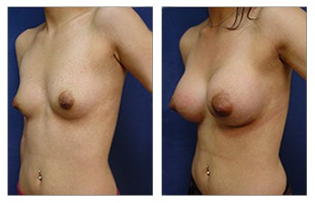 left front oblique Safest Breast Implants