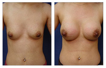 Safest Breast Implants, CPSI.
